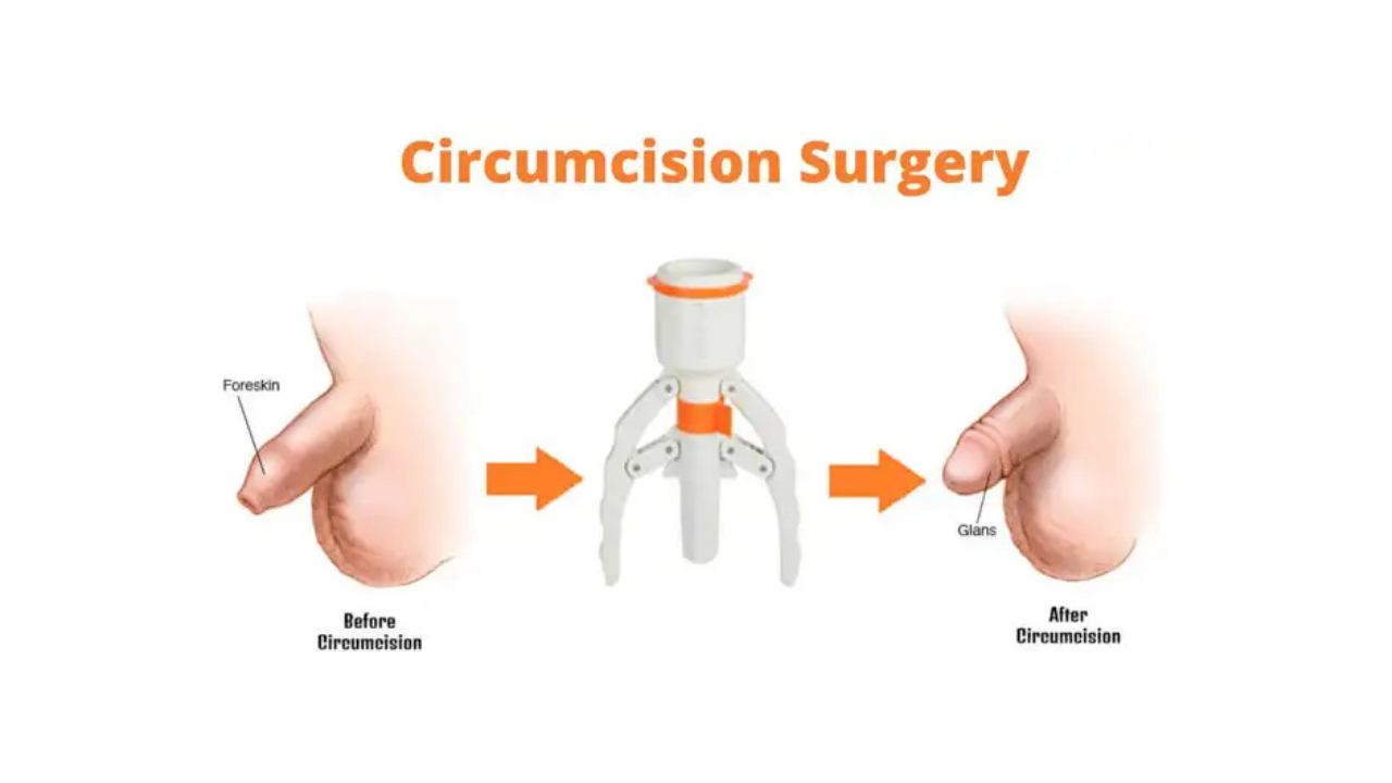ZSR Circumcision Procedure